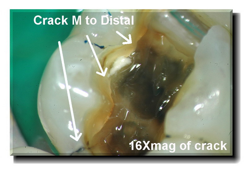 Cracked tooth pg 2 edited and magnified_resize.jpg